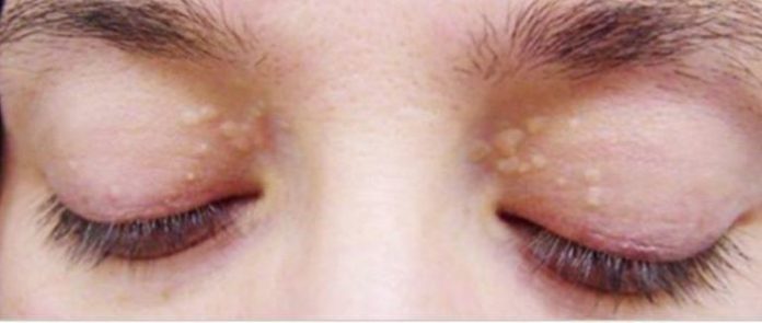 cholesterol deposits around eyes spot removing treatment