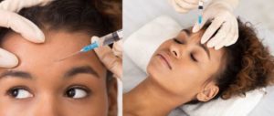 5 Important Things About Botox Treatment