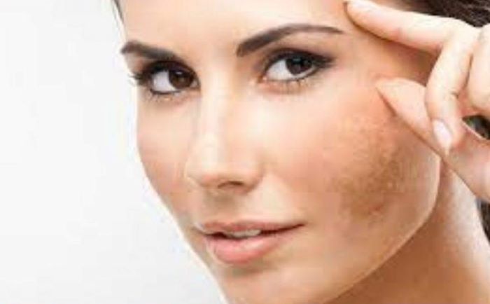 Which Vitamin Deficiency Causes Freckles?