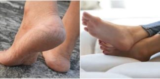 Home Remedies to Get Treatment for Cracked Heels