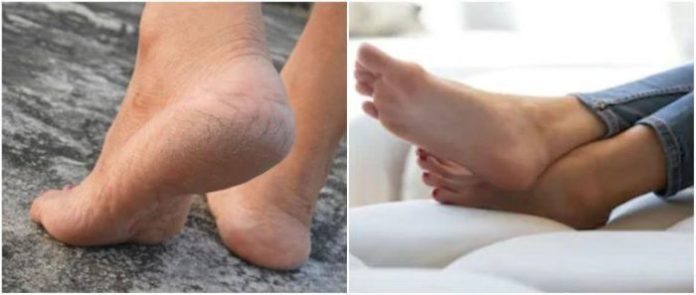 Home Remedies to Get Treatment for Cracked Heels