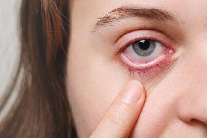 Home Remedies for Eye Infection – Remedy for Eye Infection