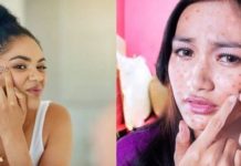 5 Habits That are Increase Your Acne and Making it Worse