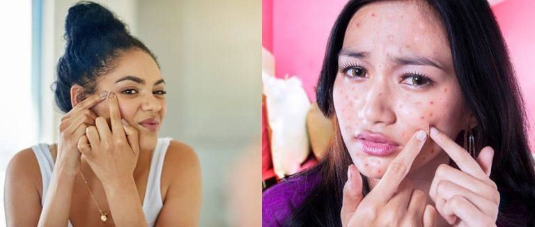 5 Habits That are Increase Your Acne and Making it Worse