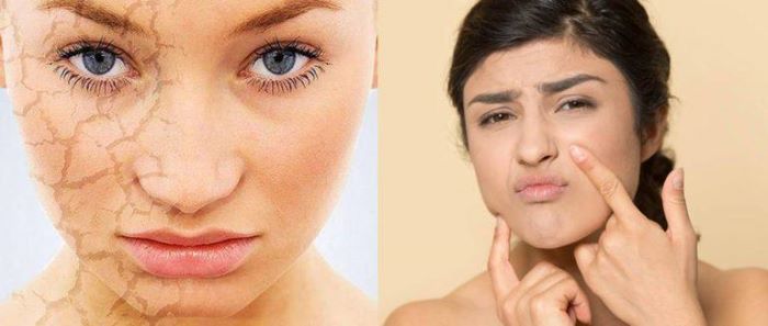 Home Remedies to Take Care of Dry Skin - Dry Skin Care