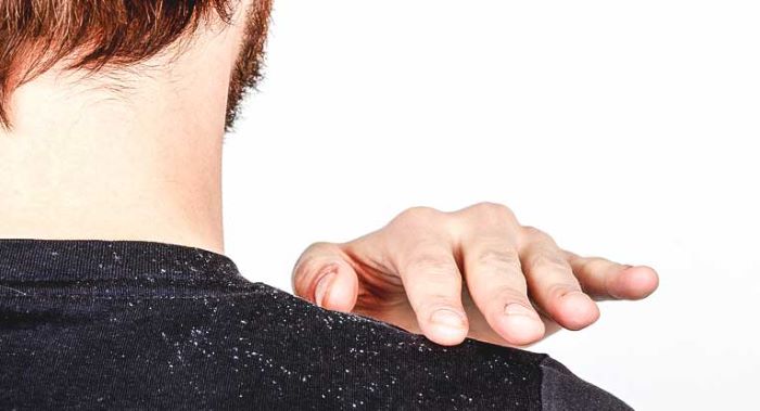 Dandruff Vs Dry Scalp: Causes, Treatment, and Prevention